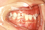乳歯の時期から治療を開始